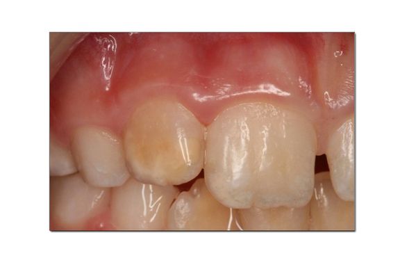 Har barn «plutselig» fått emaljefeil på tennene? Nå undersøkes 3000 barn for å finne ut hvorfor det skjer. 
