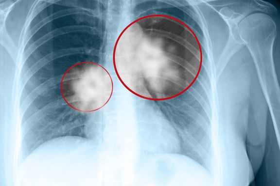 Lungekreft blir oversett eller feiltolket