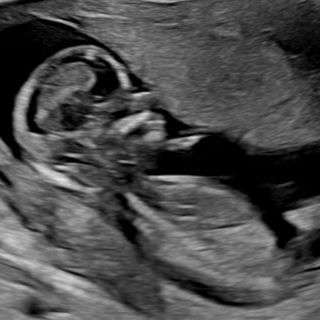 Regjeringen lovet tidlig ultralyd til gravide i år. Det løftet sprekker.