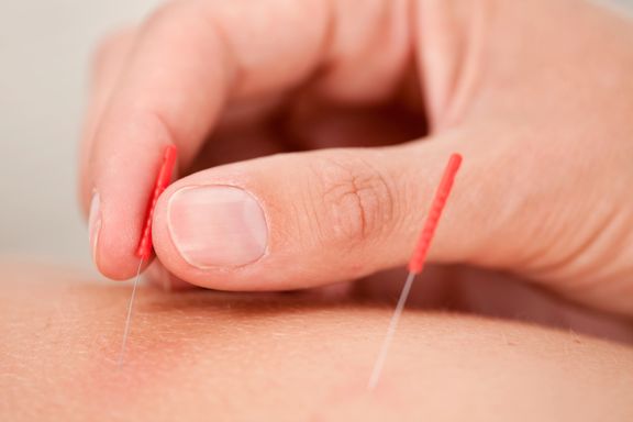 Akupunktur hører ikke hjemme på fødestuen