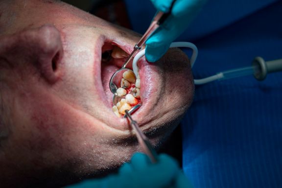 200.000 kan få lavere utgifter hos tannlege med egenandelstak på 12.000 kroner i året