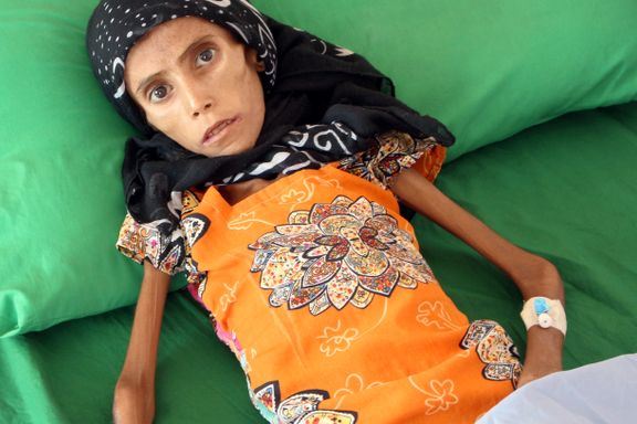 Hun er 12 år og veier 10 kilo. 24 millioner mennesker trenger hjelp i verdens verste krise. 