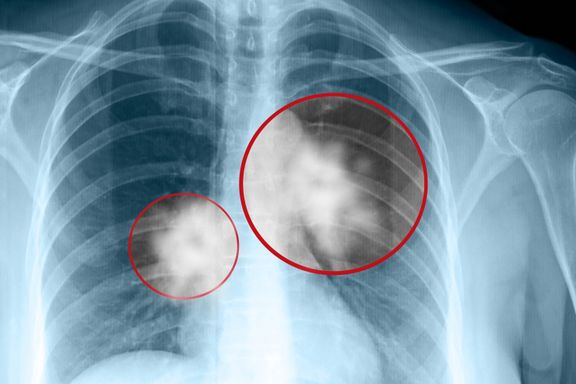 Fagråd: To norske sykehus bør slutte å operere for lungekreft