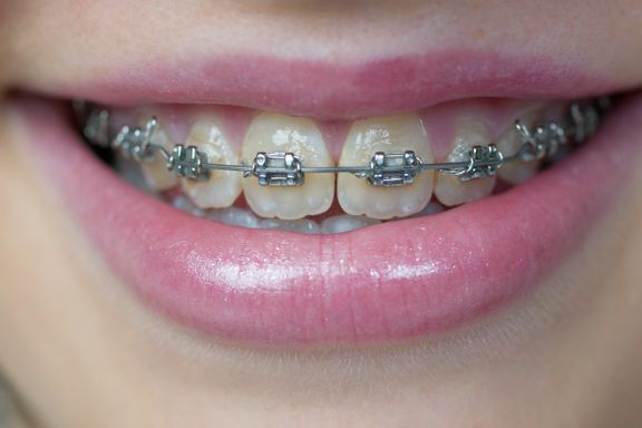 7800 barn kan miste offentlig støtte til tannregulering