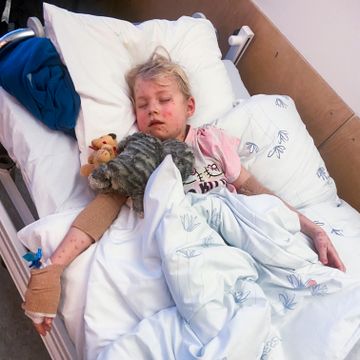 Klara (6) måtte på sykehus med vannkopper. Flere barn blir alvorlig syke.