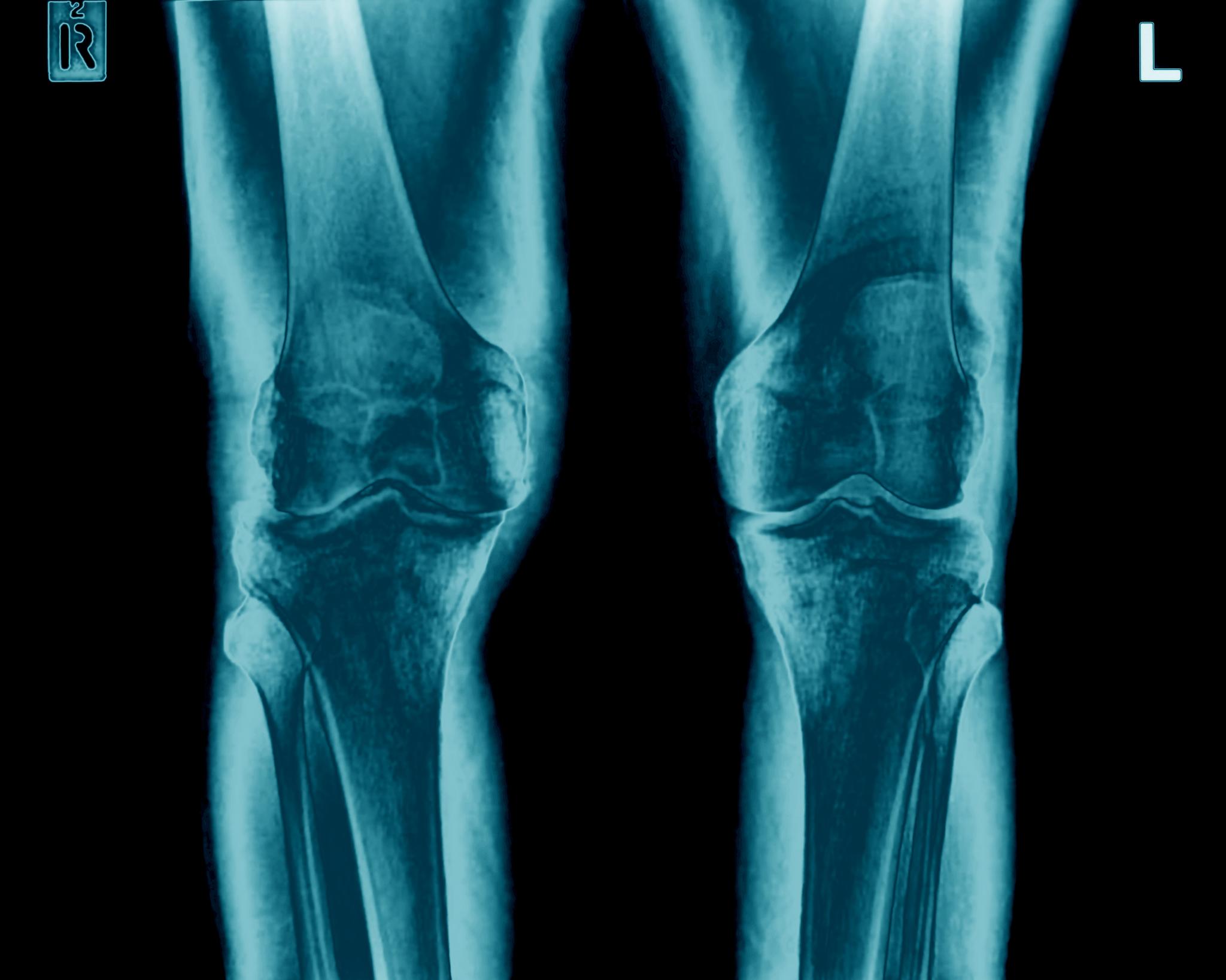 Rundt 300.000 pasienter lever med artrose i Norge i dag. Sykdommen kan for eksempel starte i en skade i brusken. Her ser vi artroserammede knær. 