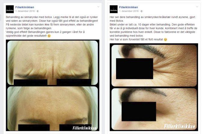Fillerklinikken har utstrakt bruk av før- og etterbilder i sosiale medier, som de skriver at er et resultat av Botox-behandlinger. Foto: Skjermdump