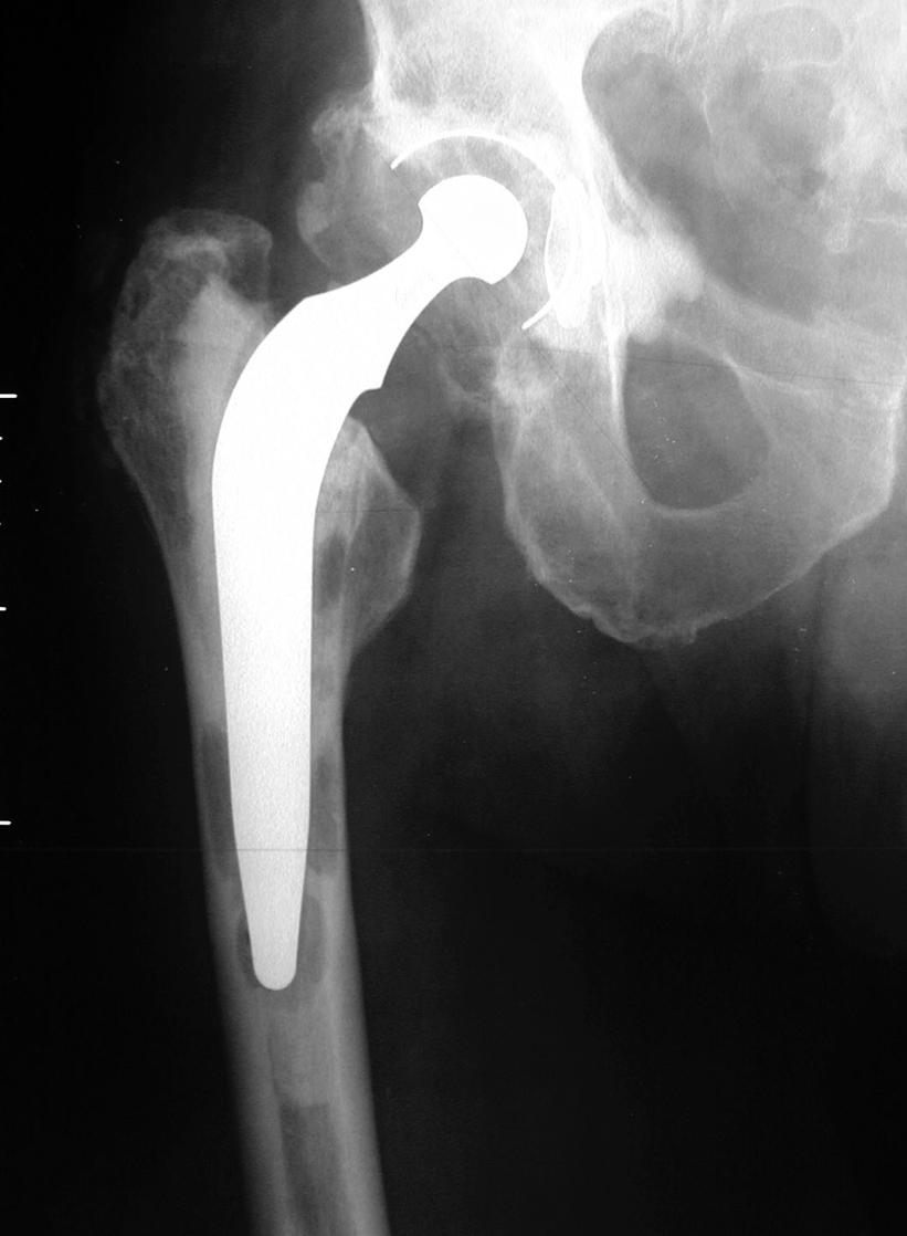 Røntgenbildet viser en løs hofteprotese, festet i den danske bensementen Boneloc. 