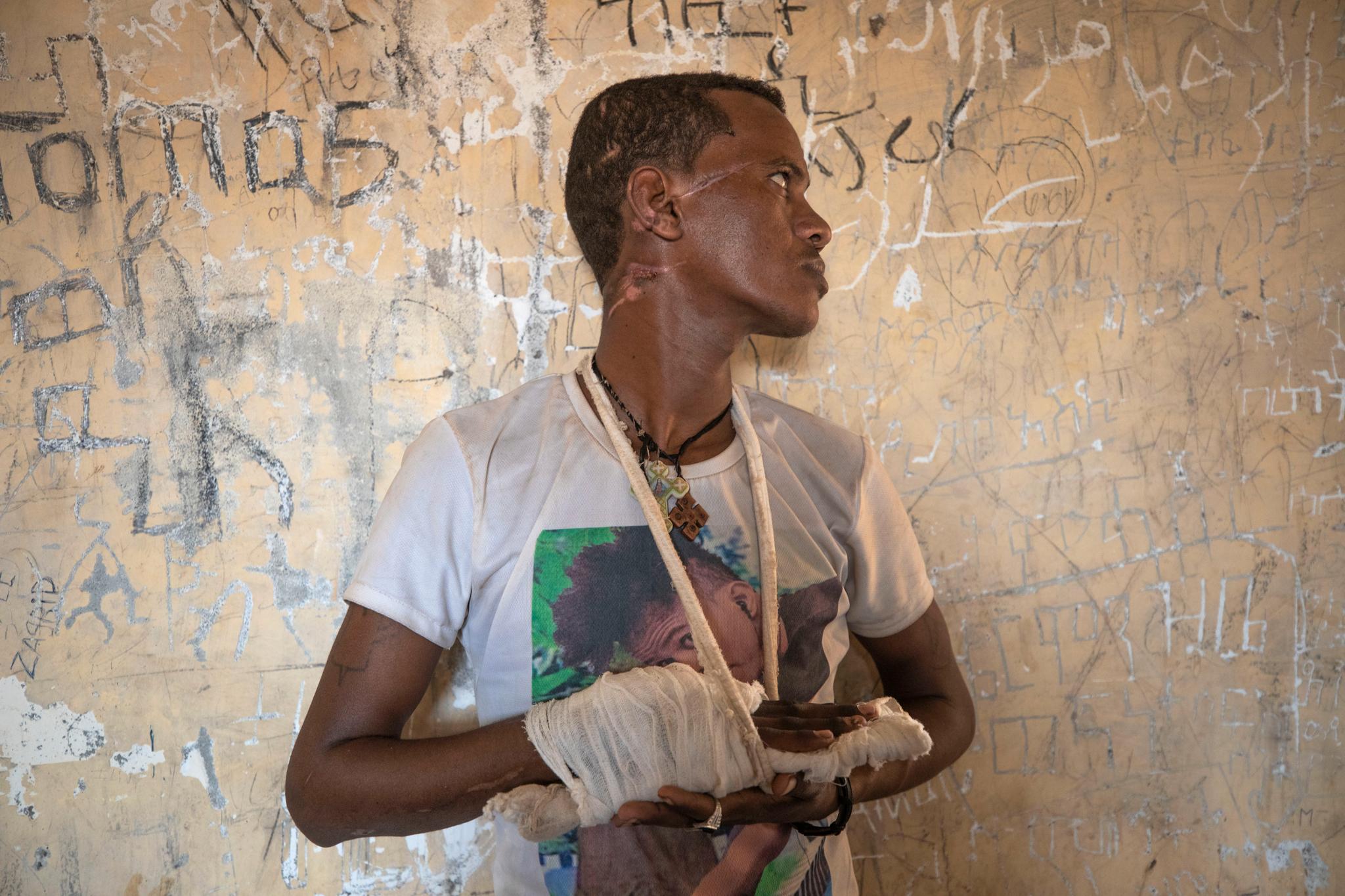 22 år gamle Abrahaley Minasbo fra Mai-Kadra i Tigray-regionen viser skadene han er blitt påført med machete av militsstyrken Al Fano, som er alliert med regjeringen i Etiopia. Han oppholdt seg 15. desember i mottakssenteret Hamdeyat nær grensen til Etiopia i Sudan. 