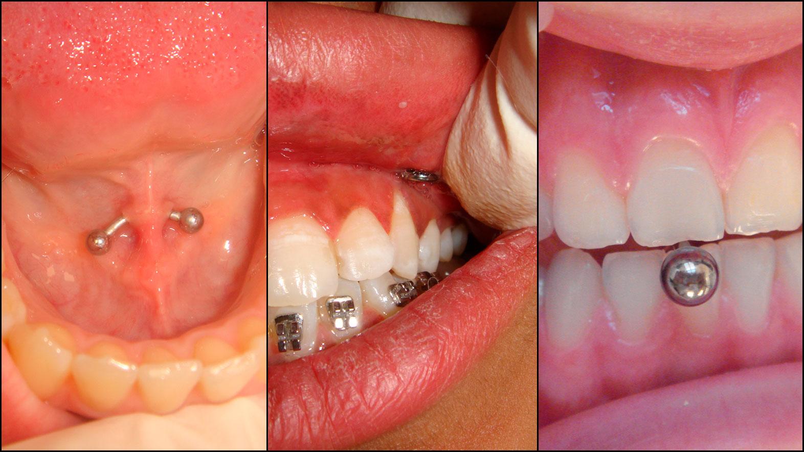 Bildet til venstre viser piercingen under tunga, hvor piercingen er festet til et område som produserer mye spytt. Får du en infeksjon, eller punkterer du spyttkjertelen, kan det få alvorlige konsekvenser. I midten har piercingen slitt vekk tannkjøttet, til høyre har den ene av fortennene blitt slipt ned av tungepiercingen. 