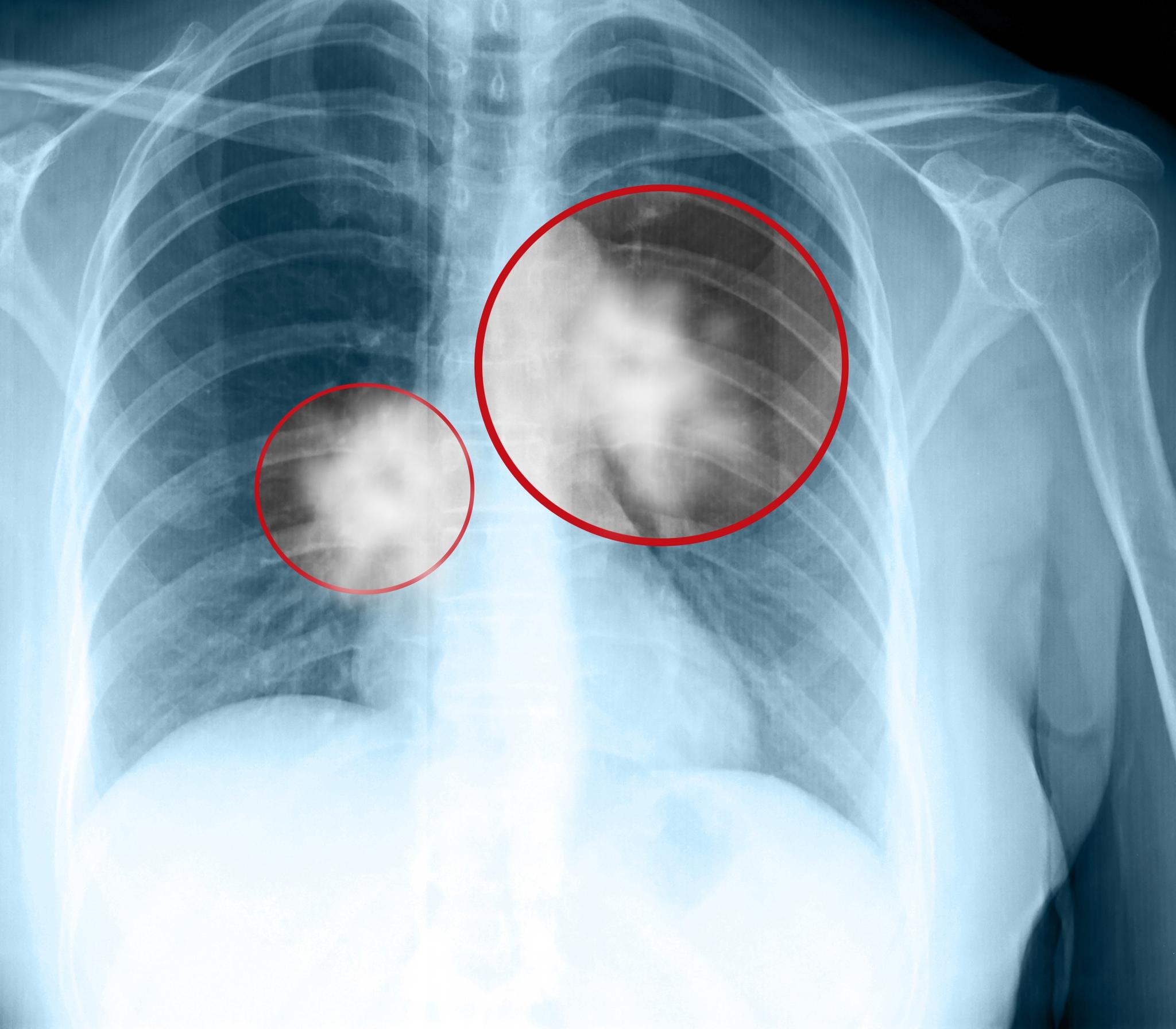 Røntgenbilde av lungekreft (innringet).