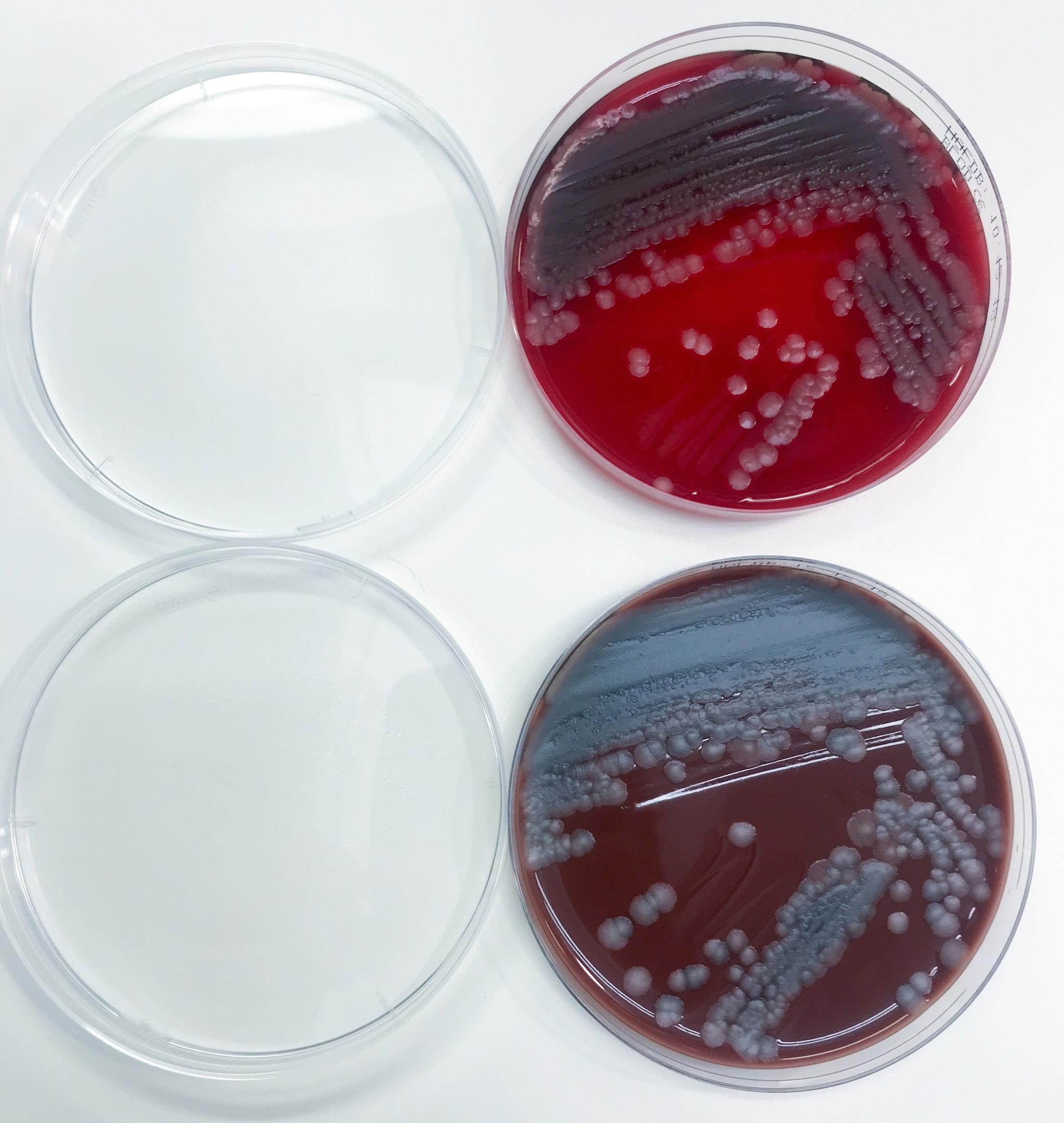 I laboratoriet på Ahus så legene at det i bakterieskålene vokste rikelig med en bakterie som produserte den samme blåfargen som viste seg i parets svette. 