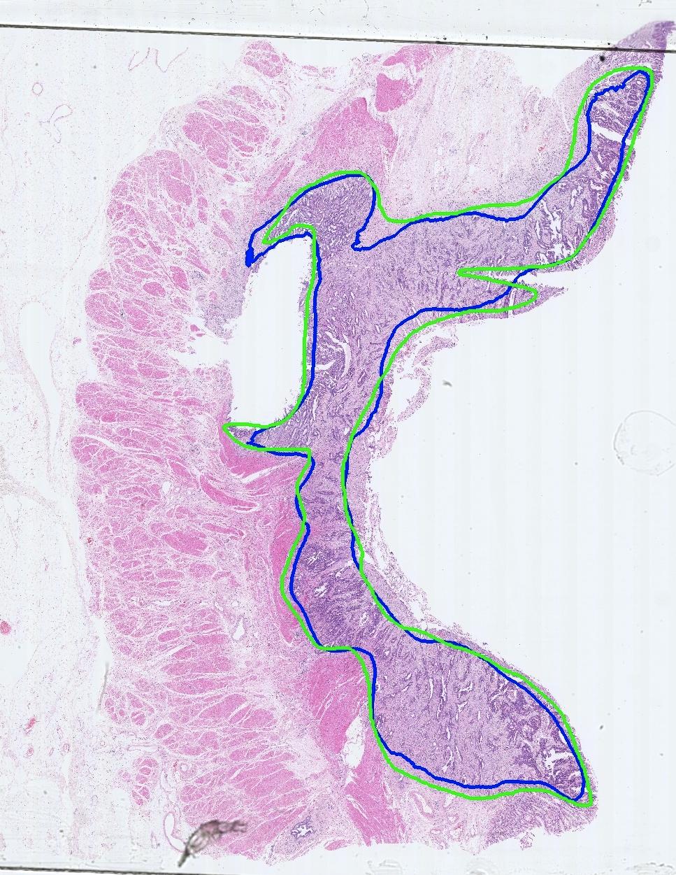 Den blå linjen viser automatisert markering av kreftområdet i en svulst. Den grønne linjen er manuell markering utført av en patolog. 