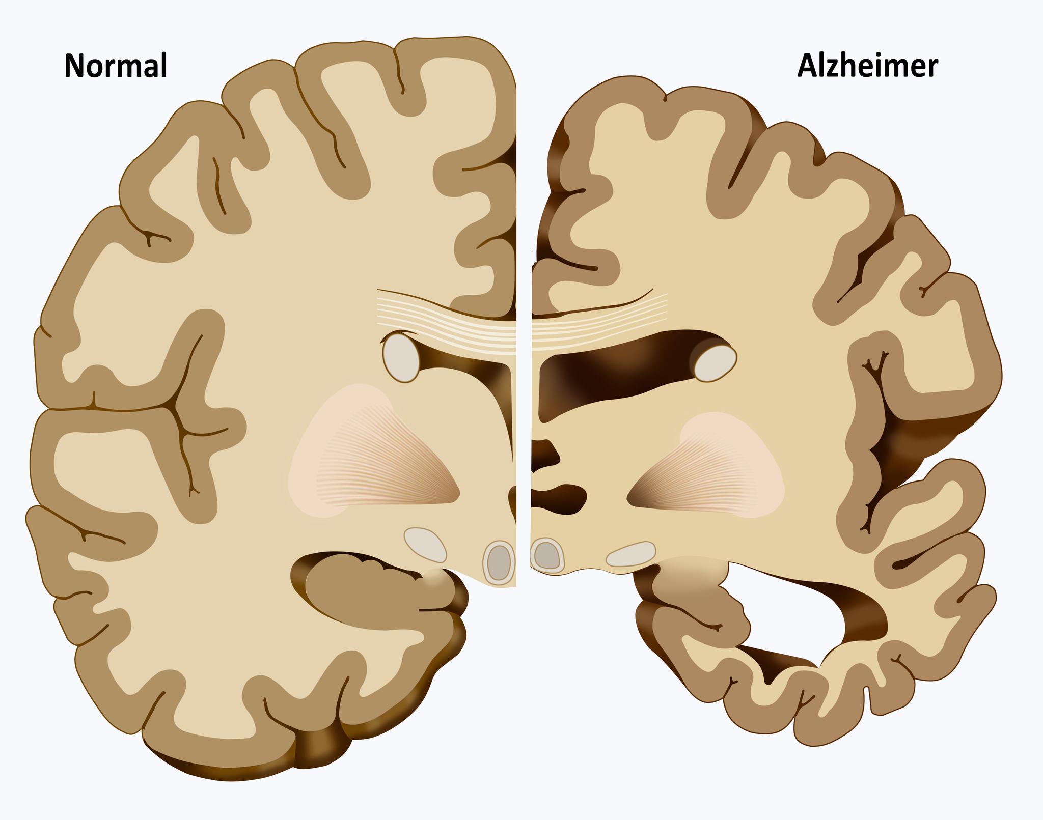 Alzheimer fører til at hjerneceller dør og delvis erstattes med støtte- og bindevev. Fenomenet kalles hjernesvinn eller hjerneatrofi.