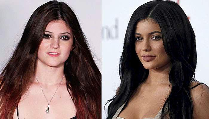 Etter ett år med rykter, bekreftet Kardashian-søster Kylie Jenner at hun hadde fylt opp leppene sine. Hun var da 16 år. – Det var bare noe jeg hadde hatt lyst til å gjøre lenge. Leppene har alltid vært en usikkerhet for meg, sa hun i en episode av reality-serien Keeping Up With The Kardashians tilbake i mai 2015.