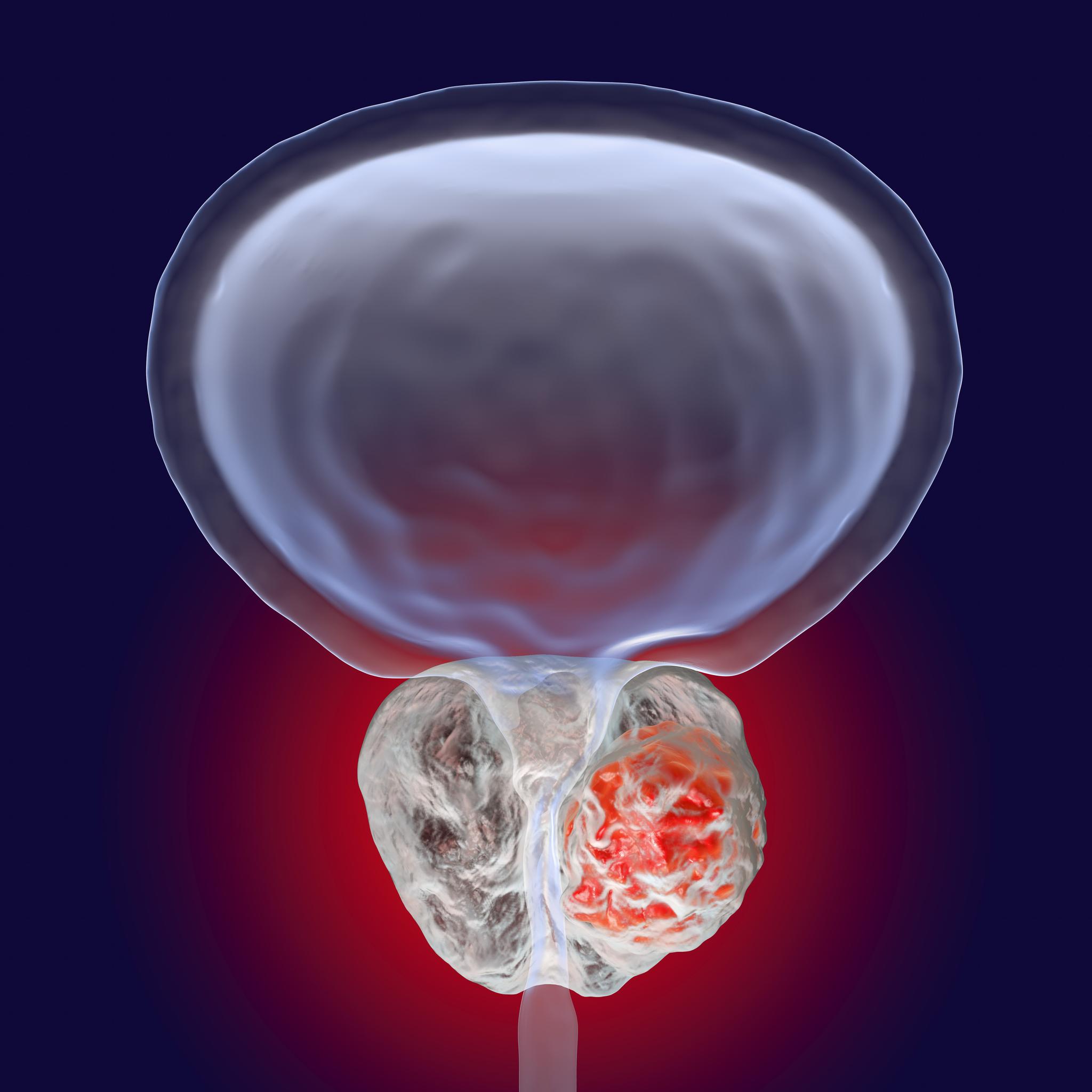 Bildet viser en 3D-illustrasjon av kreft i prostata. Rundt 1000 norske menn dør av krefttypen hvert år. 