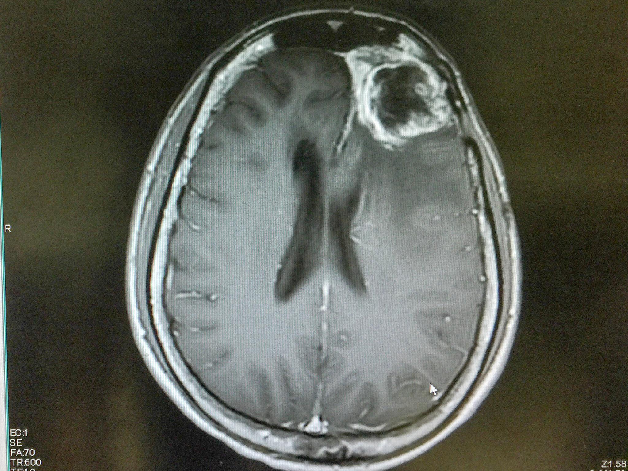 Glioblastom er den vanligste formen for hjernekreft. Her vises en slik hjernesvulst på et MR-bilde.