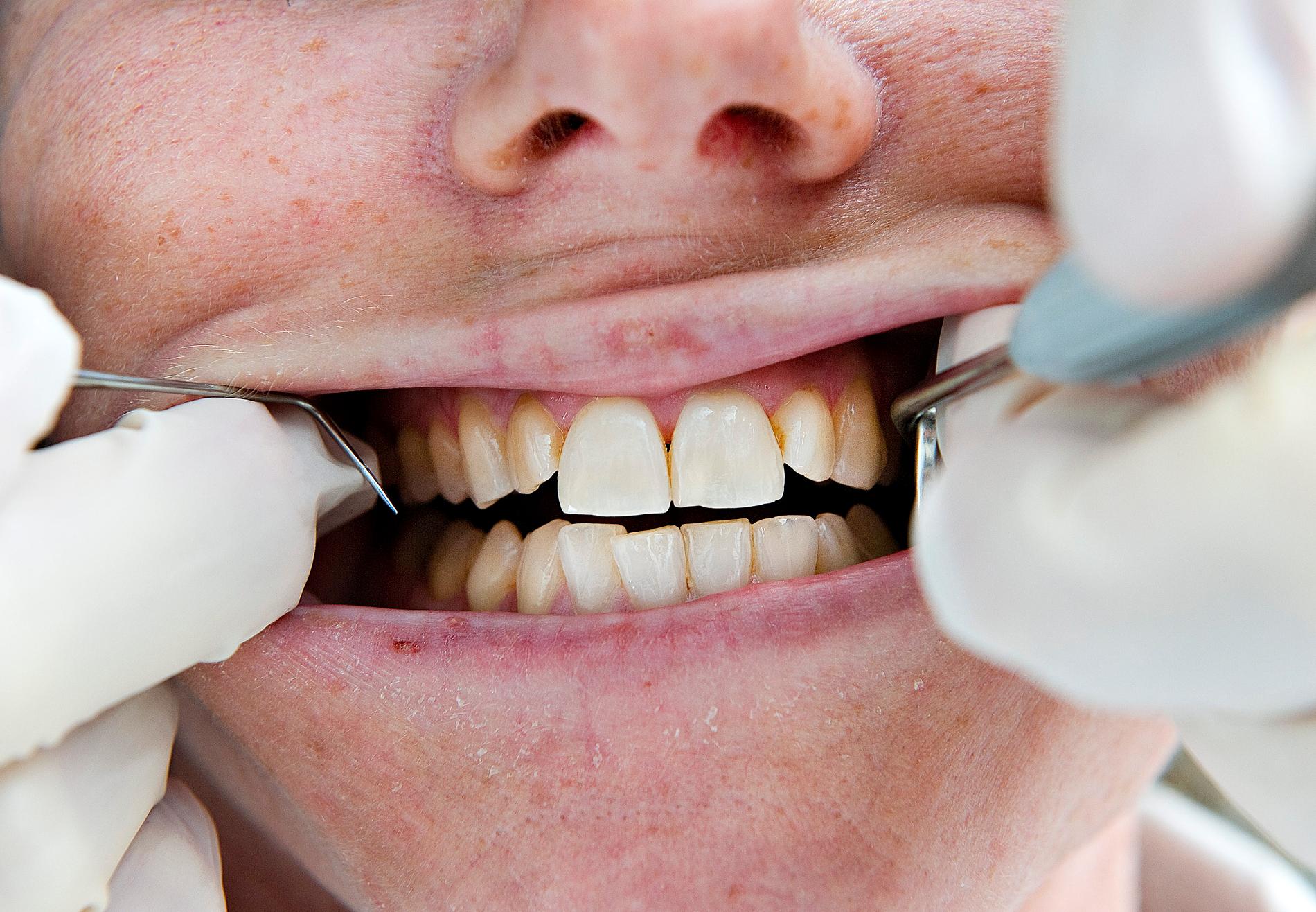 Du kan spare opp til 650 kroner på å velge den billigste tannlegen i Stavanger.