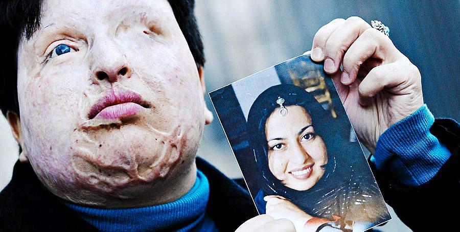 Iranske Ameneh Bahrami viser frem et bilde av seg selv fra før hun fikk kastet syre i ansiktet av en forsmådd frier. Lørdag kan hun selv blinde gjerningsmannen.