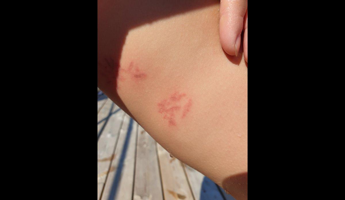 SÅR: Brannskade på arm etter kontakt med svi-anemonene som er funnet i Hordaland.