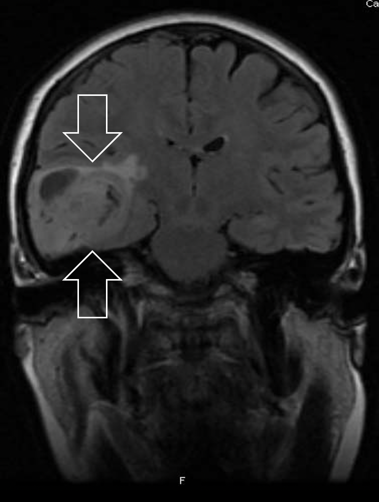 MR-bilder av hjernen til en pasient sett rett forfra. Bildet viser et glioblastom (hvite piler) i høyre tinninglapp. 