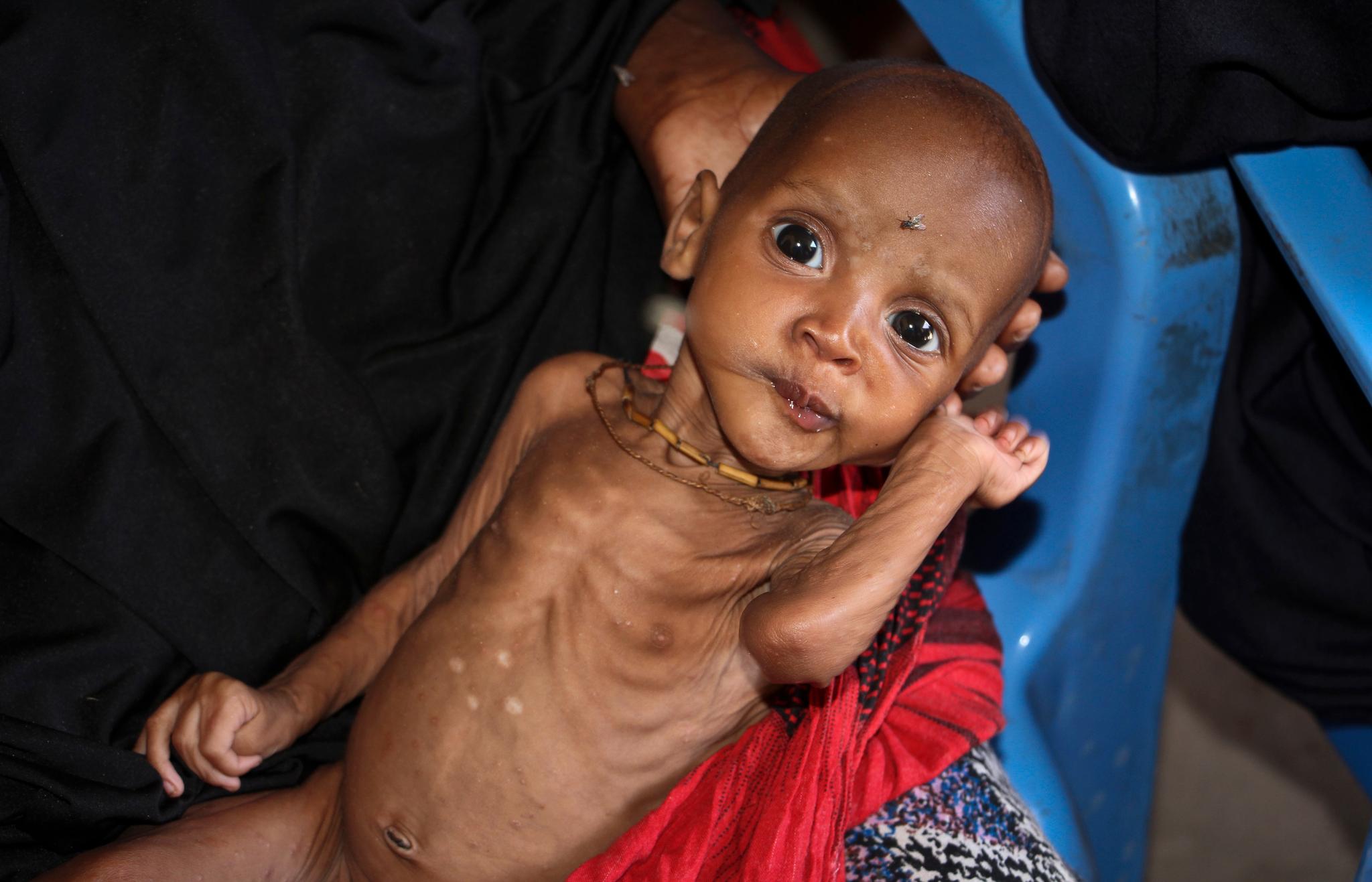 Ni måneder gamle Ali Assan er underernært på grunn av tørken som har rammet Somalia. Ifølge FN er 900.000 somaliske barn underernært.