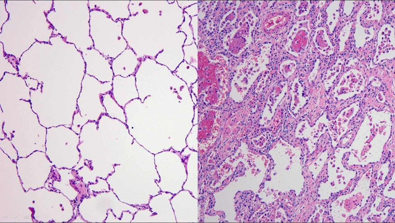 Bildet viser en normal lunge (til venstre) og en skadet lunge (til høyre). Pasienten med den skadede lungen har covid-19. 